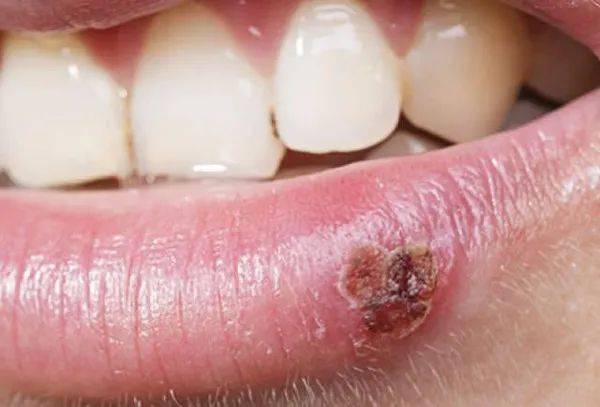 2024年生殖器疱疹攻克进展,连贯性方法执行评估_VFL27.121便携版