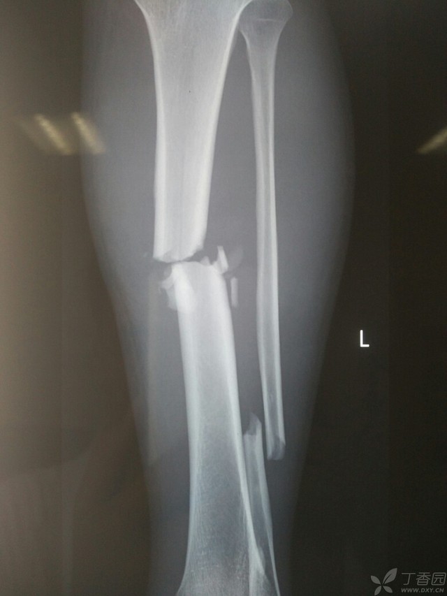 科技重塑胫腓骨骨折康复之旅,引领未来体验新篇章