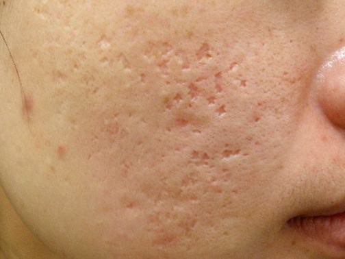 最新痘坑抚平神器，科技重塑肌肤之美，自信生活从此开始