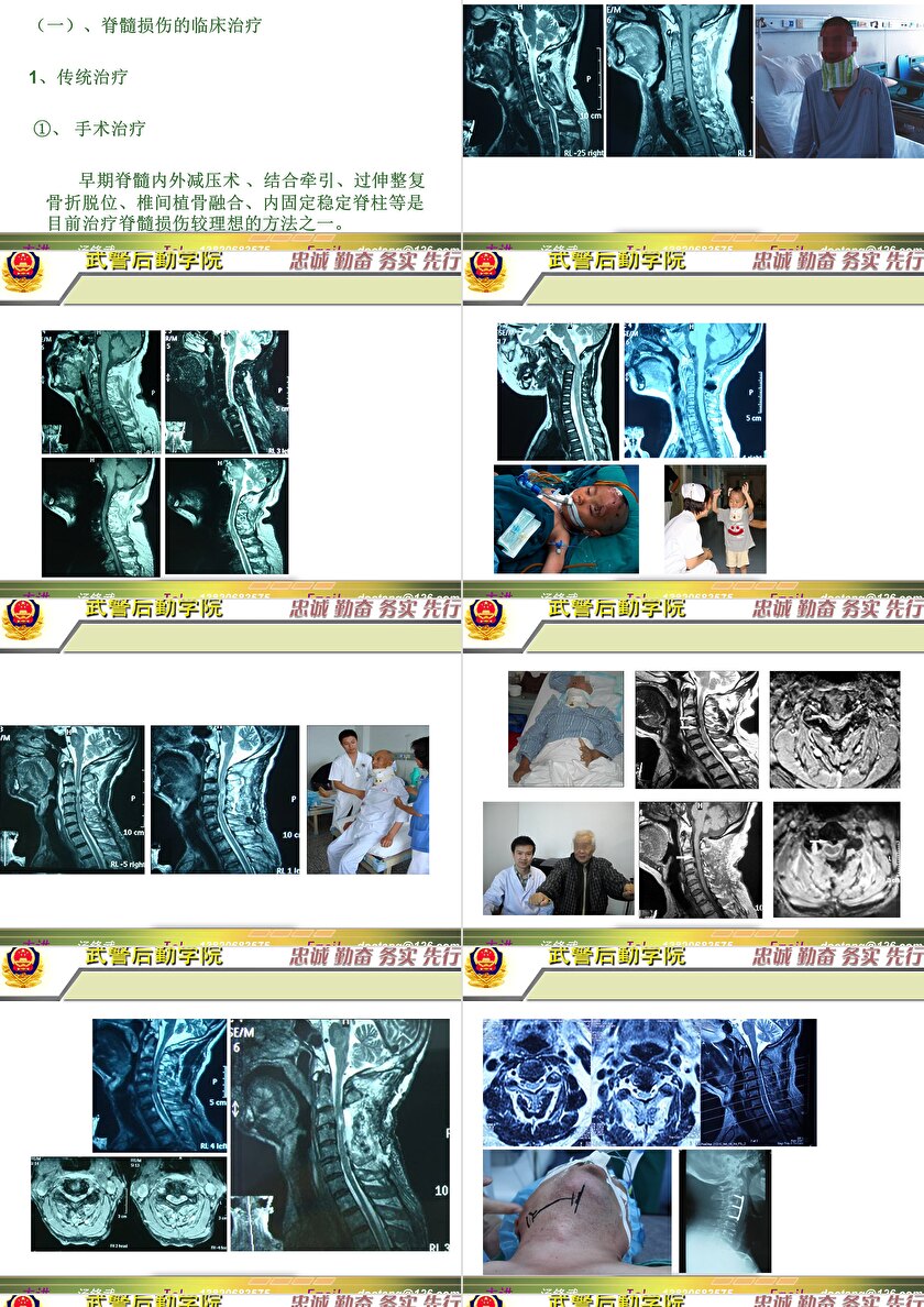 2023年脊髓损伤研究新进展，里程碑式的突破与日常奇妙变化