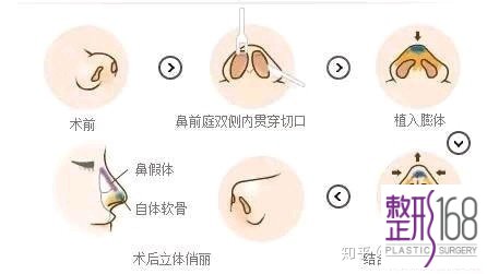 最新鼻整形技术重塑自信,焕发新生之美