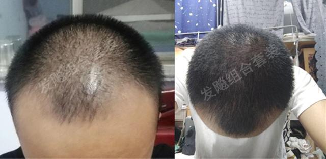 治愈脱发最新重大突破，重塑自信，希望之光再现