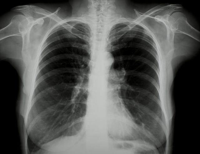 抚顺肺炎最新动态与全面步骤指南
