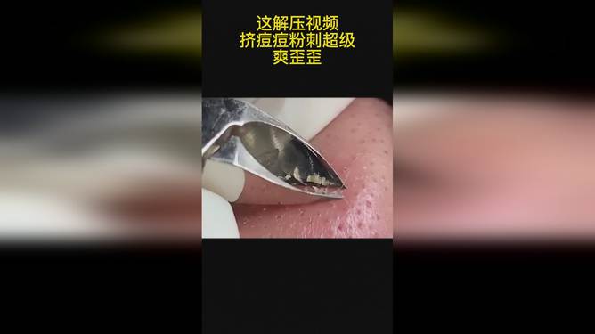 最新挤脓包视频，见证变化的力量，自信与成就感的诞生之地