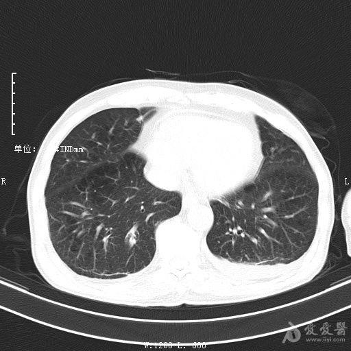 最新肺炎求助急需关注与帮助