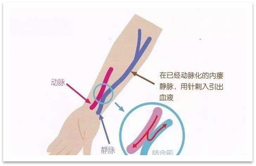 静脉瘘最新资讯，掌握最前沿的健康信息