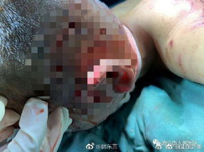 最新肌肉注射的日常趣事分享